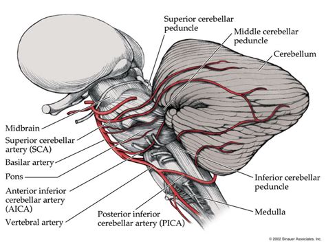 pica dura|Extradural origin of the posteroinferior cerebellar artery: .